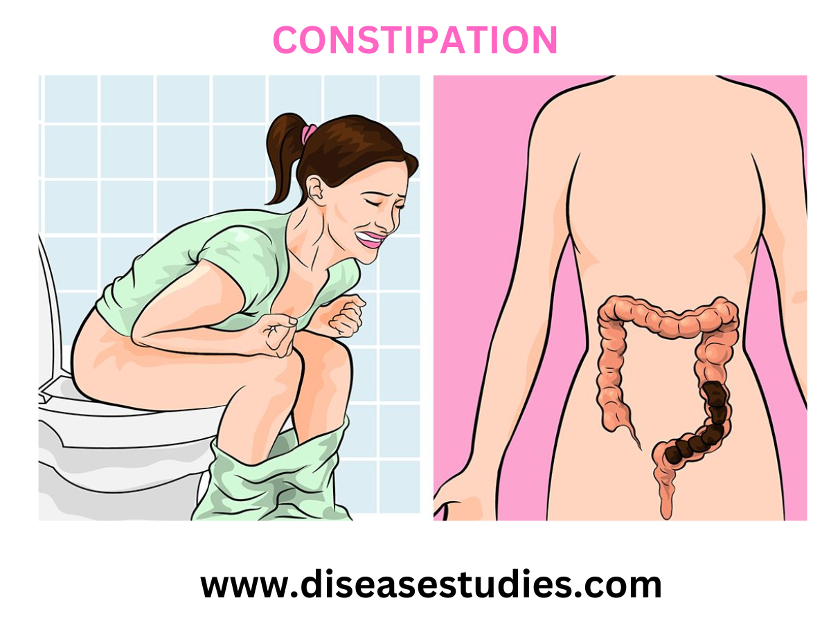 Constipation