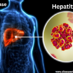 Hepatitis A