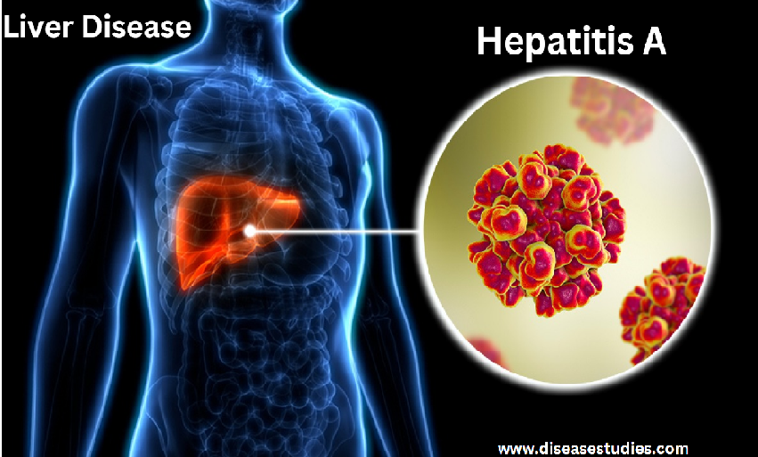 Hepatitis A