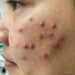 Skin Pimples in the USA